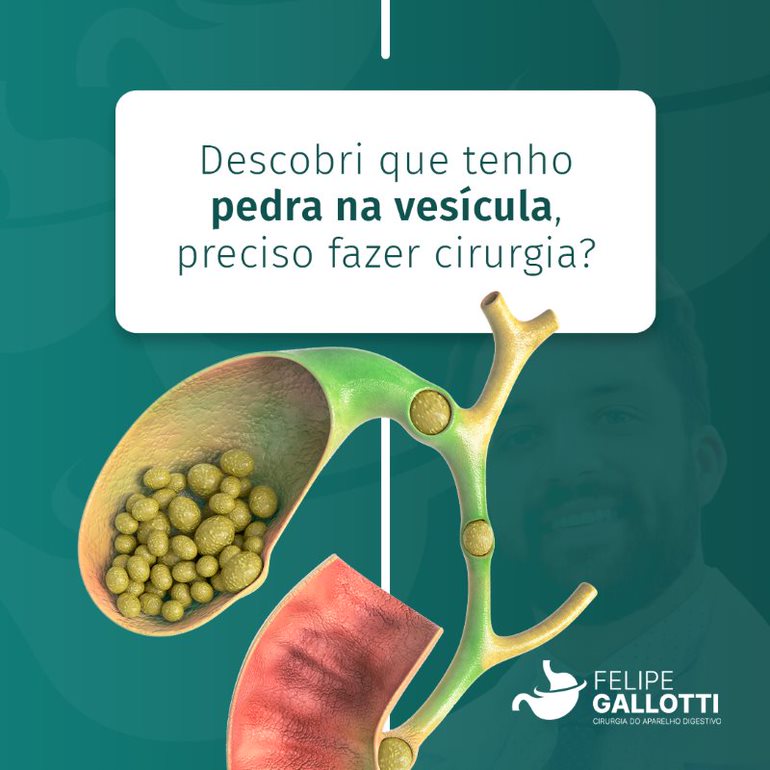Descobri que tenho pedra na vesícula, preciso fazer cirurgia?